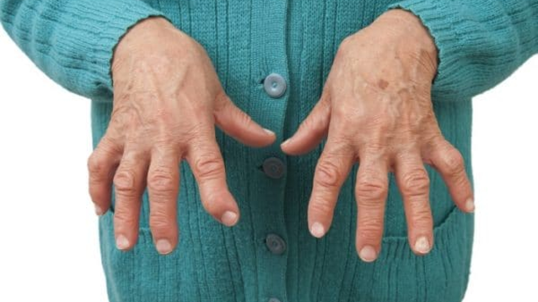 La artritis reumatoide afecta mucho más que las articulaciones: hasta 1 de cada 2 pacientes sufre síntomas depresivos
